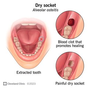dry socket